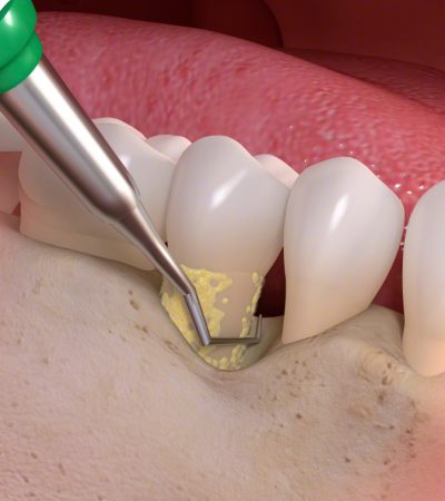 Behandlung von Zahnfleischerkrankung_03