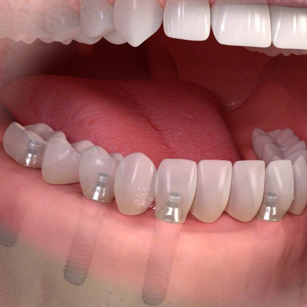 Zahnersatz auf Implantate Köln