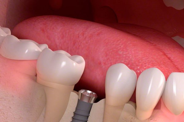 Implantat ohne Zahn in Luecke Köln
